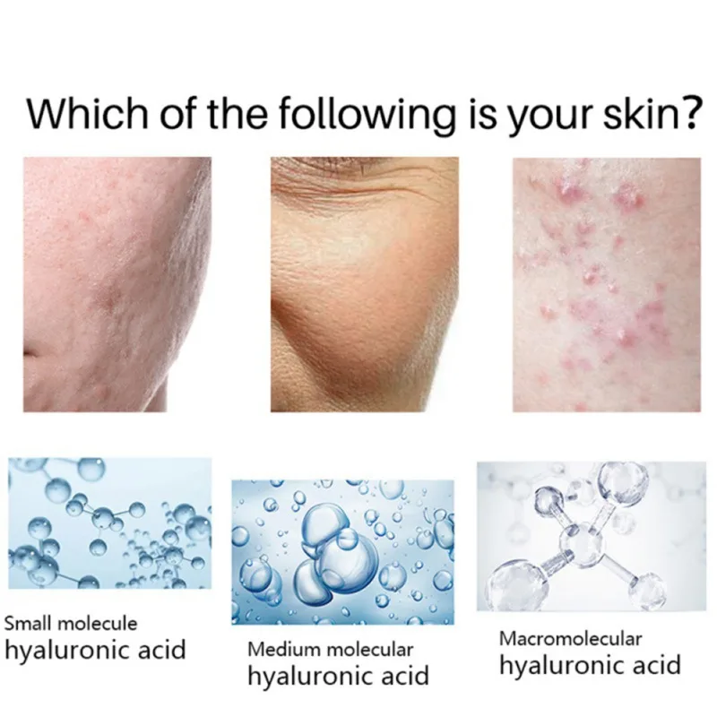20% De Ácido Glicólico + Ácido Salicílico Essência De Poros Diminuindo Esfoliante De Tratamento De Acne, Clareamento Da Pigmentação De Cuidados Da Pele Facial Imagem 5